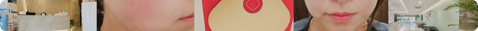 볼뉴머리프팅 후기