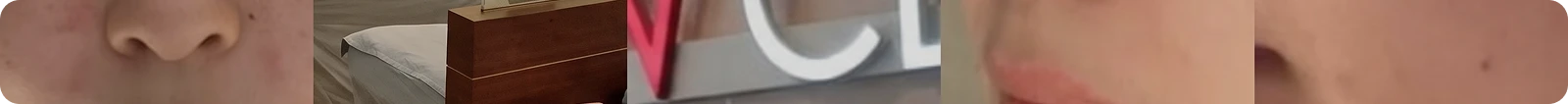 종아리보톡스 후기