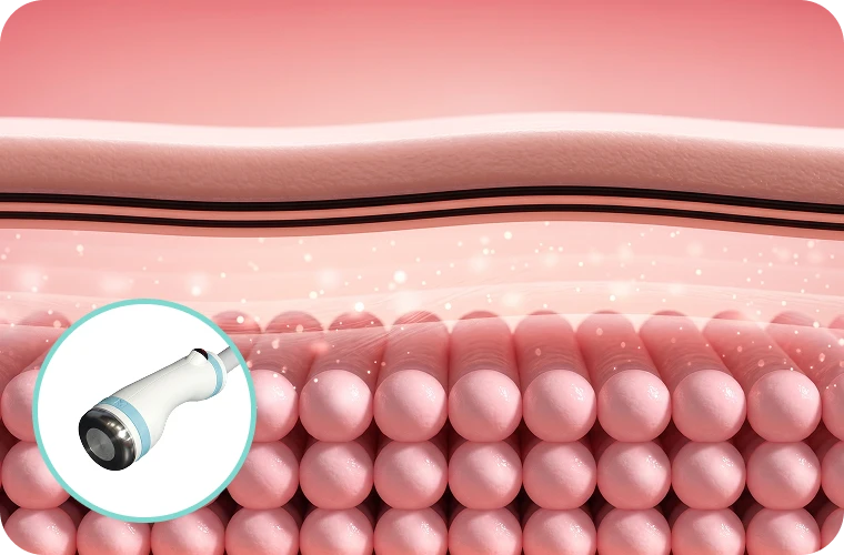 3mm (리프팅) 핸드피스