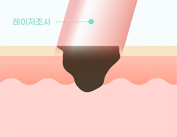 피코초 단위 레이저 조사