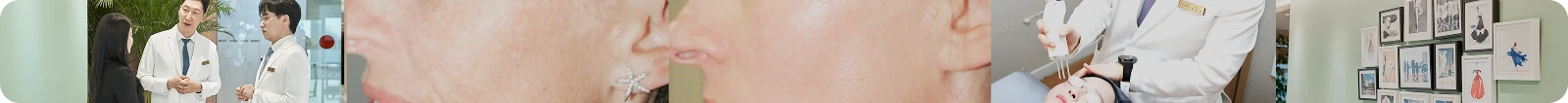 레이저토닝 후기 03