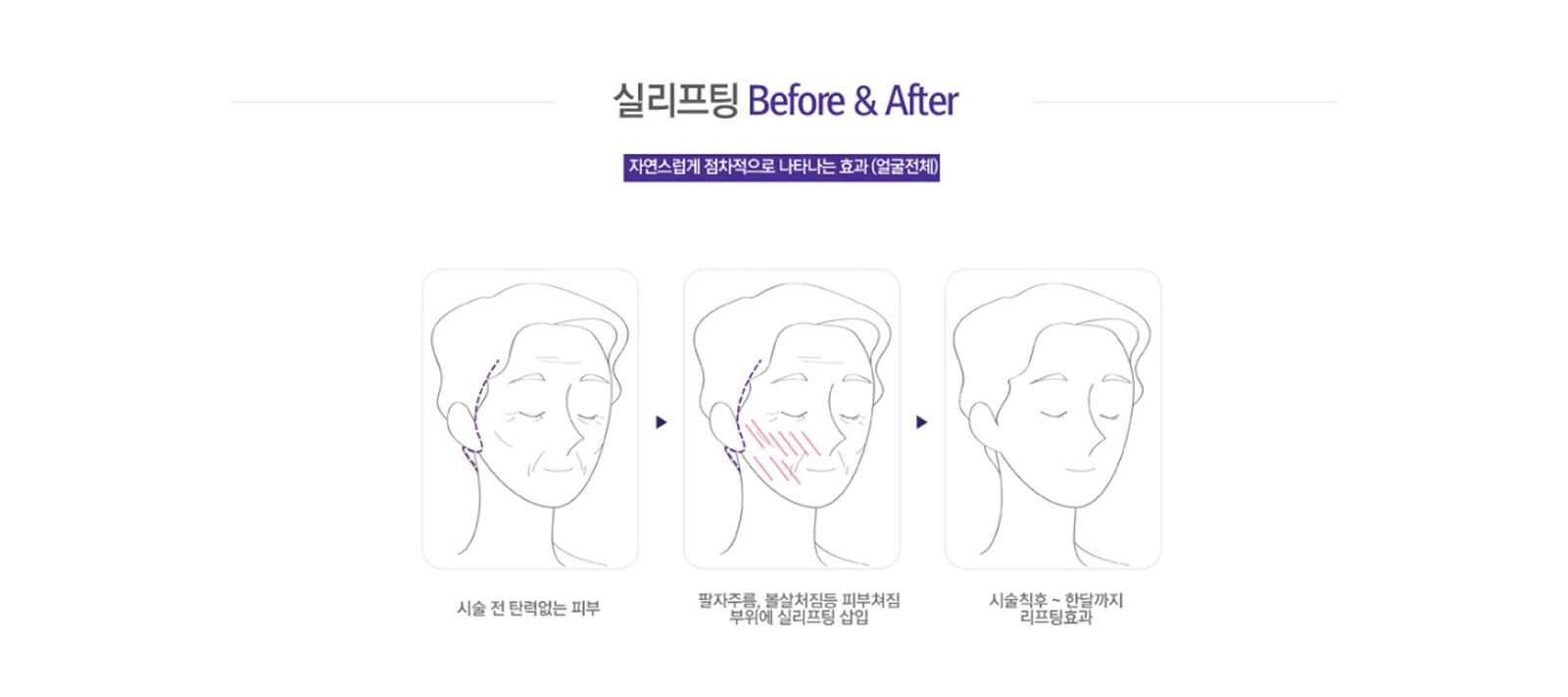 실 리프팅 시술 전후