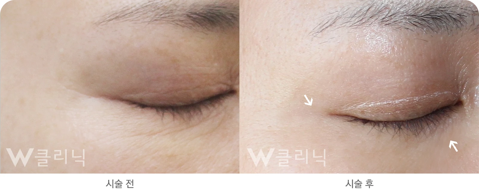 리쥬란 힐러 전후사진