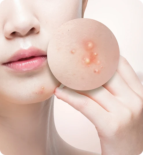 Acne Care | 여드름관리(기본)