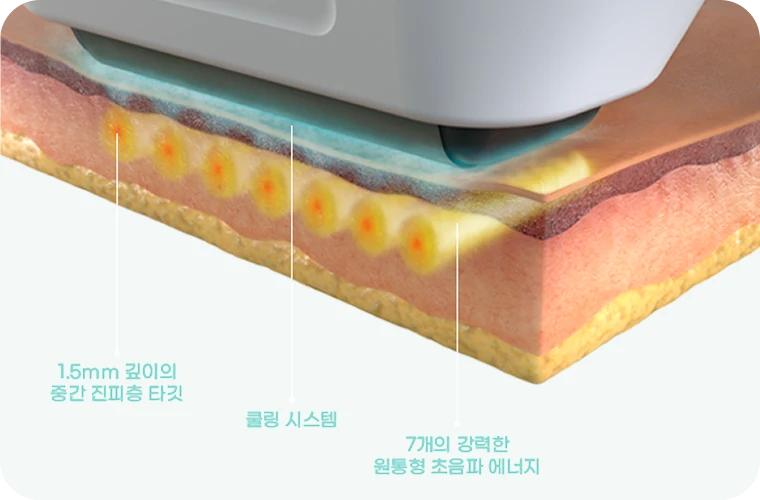 초음파 리프팅 이미지
