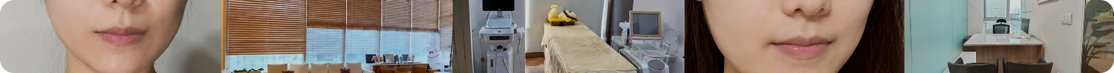 써마지 리프팅 후기