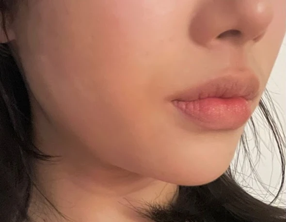 티타늄 시술 후